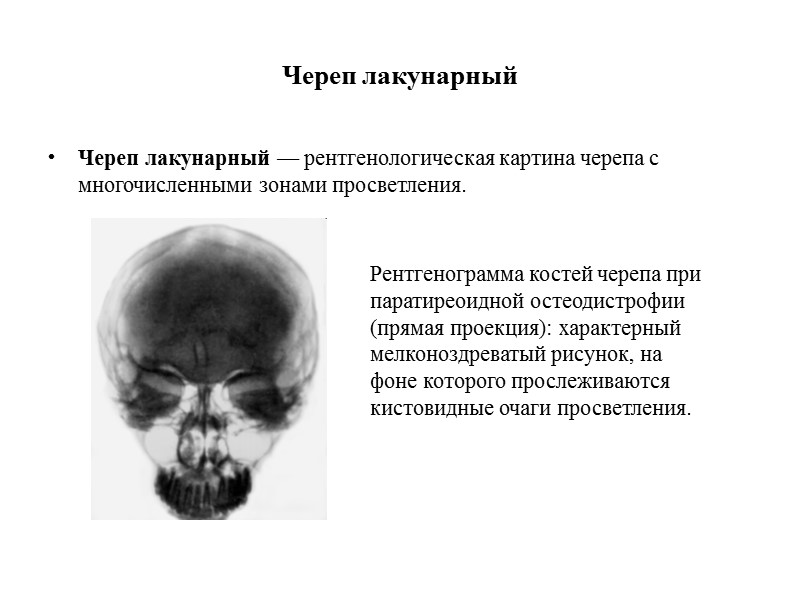 Череп лакунарный Череп лакунарный — рентгенологическая картина черепа с многочисленными зонами просветления. Рентгенограмма костей
